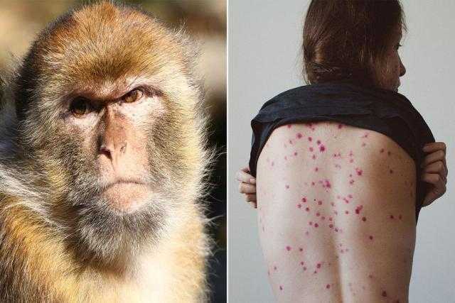 المتحدث باسم وزارة الصحة يكشف حقيقة وجود إصابات بـ«جدرى القرود»