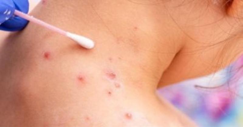  جدرى القرود