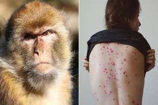 عاجل.. «الصحة» تكشف تفاصيل أول إصابة بجدري القرود في مصر