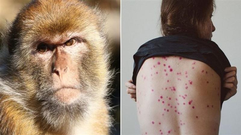 جدري القرود