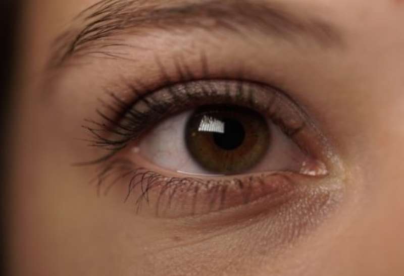 هالات سوداء تحت العين