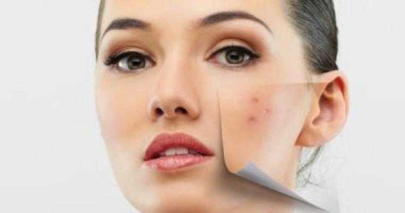 للنساء.. احذري هذه المشروبات للحصول على بشرة خالية من حب الشباب