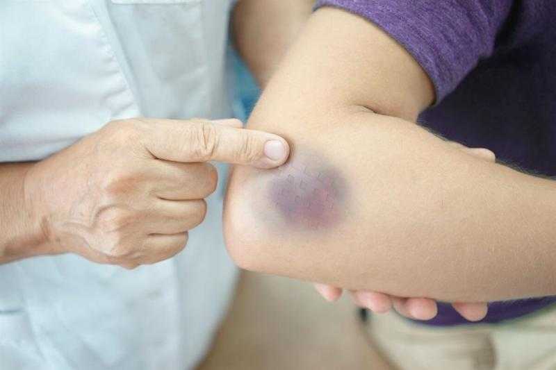 جمال شعبان يوضح متلازمة ”غاردنر دايموند GDS” الأكثر انتشارا بين السيدات