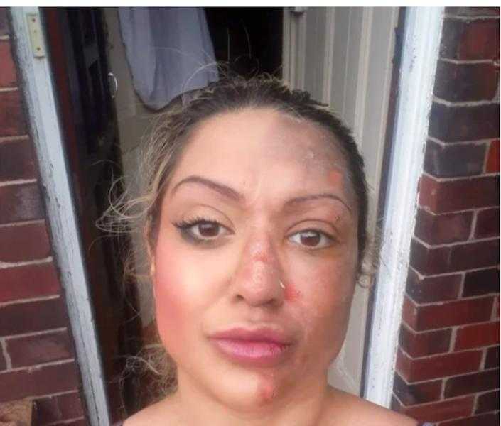 تيك توك يتسبب في تشويه وجه امرأة .. اعرف الحكاية