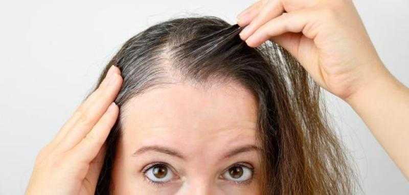 أسباب وأعراض تساقط الشعر من الأمام.. كيف تسيطر عليه؟