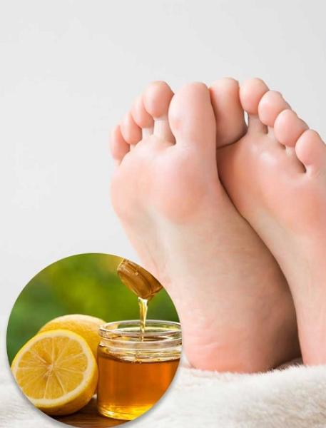 تشقق القدمين