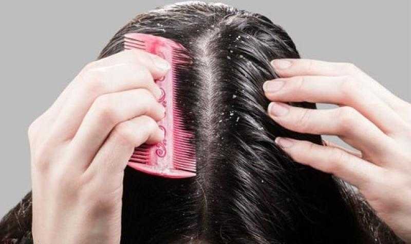 3 وصفات طبيعية للتخلص من قشرة الشعر