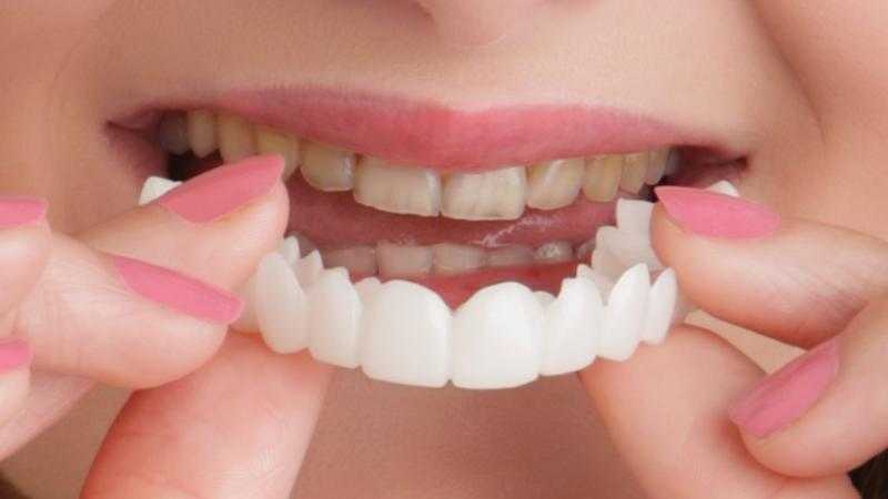 ابتسامة مشروعة، دار الإفتاء توضح حكم تركيب الفينير للأسنان