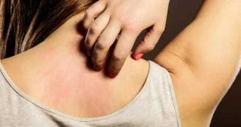 جدري الماء والطفح الجلدي: دليل شامل لكل أم لحماية طفلها وعلاج الأعراض في المنزل