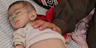مجاعة غزة تودي بحياة طفلة جديدة، 54 طفلاً ضحايا الجوع