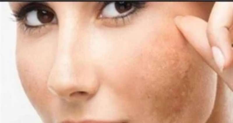 بقع جافة وخشنة