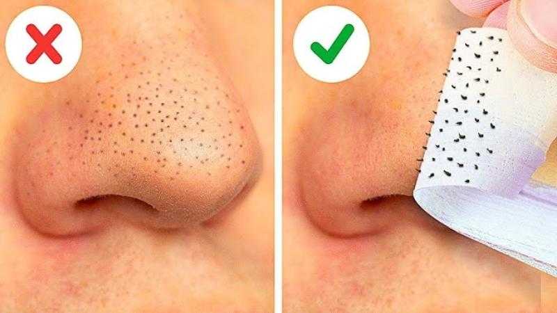 طرق مبتكرة تبدو مذهلة.. كيف تتخلص من الرؤوس السوداء دون إيذاء بشرتك؟