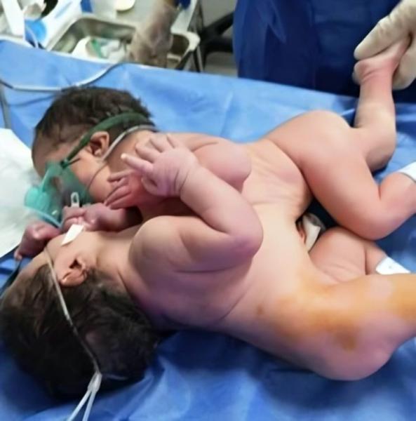 نجاح طبي نادر، ولادة توأم ملتصق في مستشفى الفيوم العام