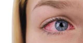 تعرف على طرق آمنة لعلاج التهابات العين منزليًا وأعراض تستوجب زيارة الطبيب