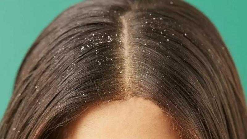 أسرار قشرة الشعر.. أسبابها وأساليب فعّالة للتخلص منها