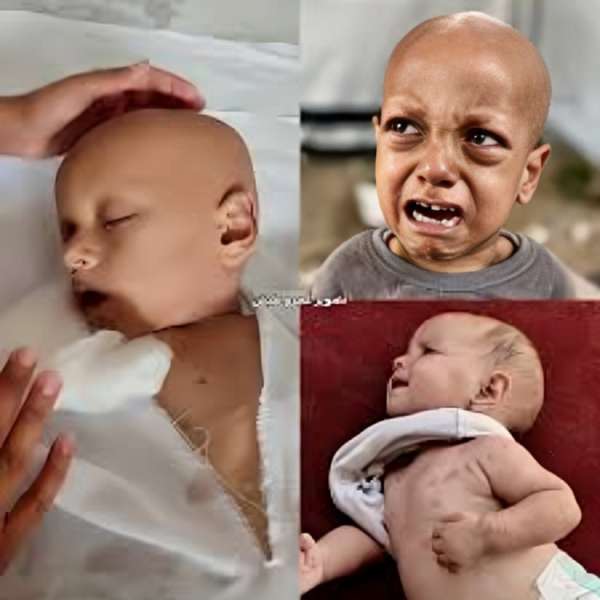 الطفلة الفلسطينية حبيبة تواجه الموت في مستشفيات تركيا بعد فقدان شقيقها