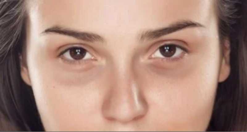 الهالات السوداء تحت المجهر.. دور التغذية والفيتامينات والعوامل الوراثية في ظهورها