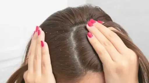 زيت شجرة الشاي.. الحل الطبيعي الفعال للقشرة