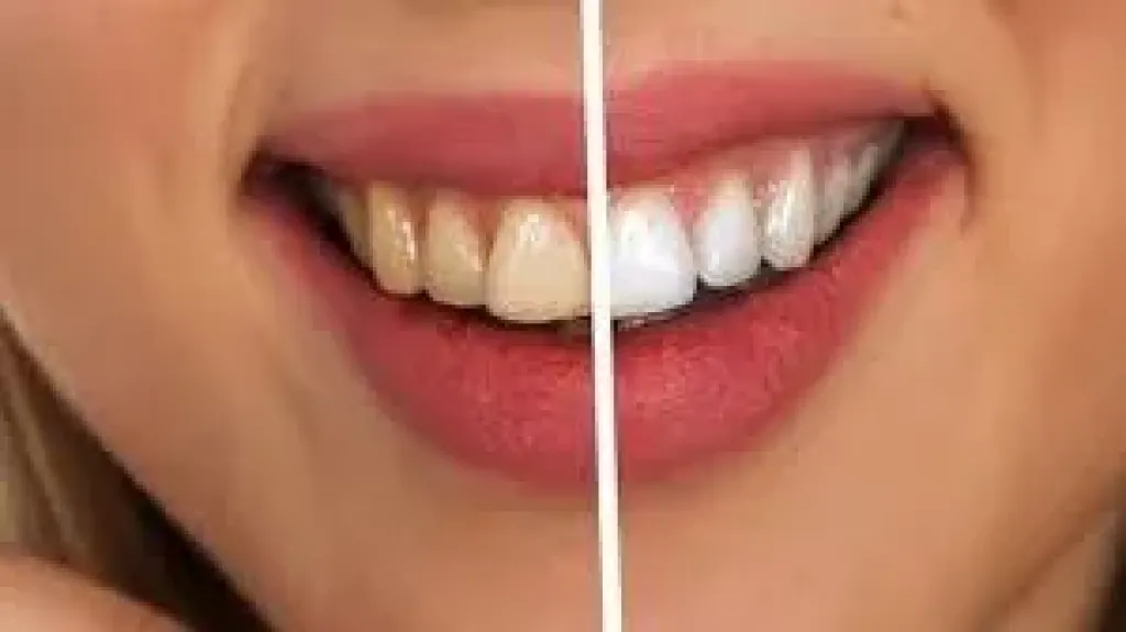 اصفرار الأسنان