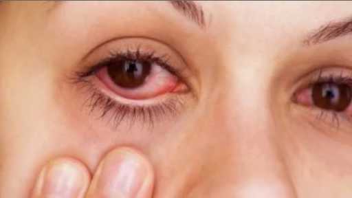 حساسية العيون.. معاناة موسمية تؤثّر على المرأة وكيفية الوقاية والعلاج