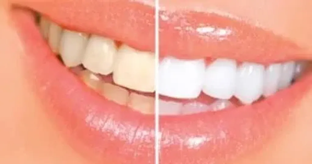 أصفرار الأسنان