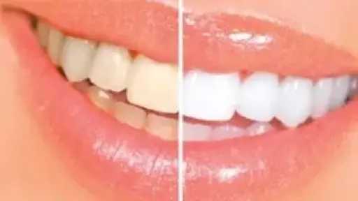 أصفرار الأسنان: أسبابه وكيفية الوقاية.. دليلك للحفاظ على ابتسامة مشرقة