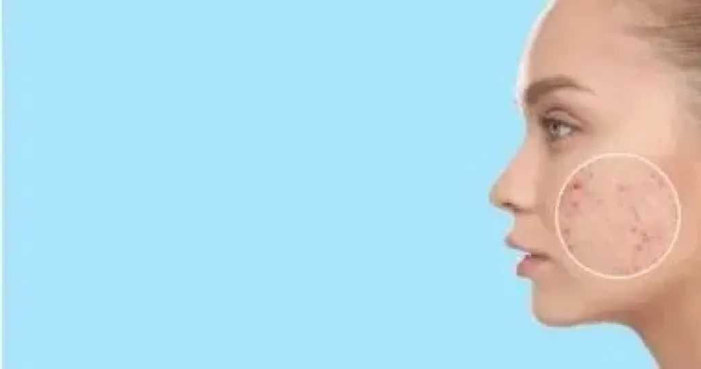 حب الشباب.. تحدٍ مزدوج للنساء بين الهرمونات والعادات اليومية حب الشباب.. تحدٍ مزدوج للنساء بين الهرمونات والعادات اليومية