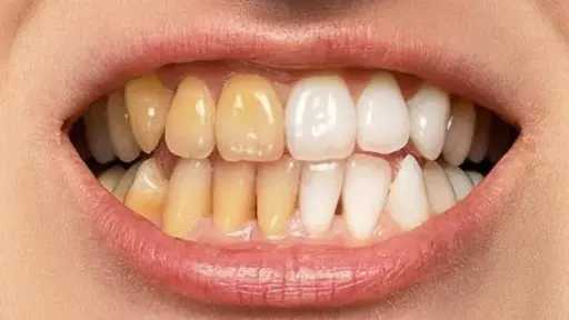أسرار ابتسامة ناصعة.. مشروبات تسبب اصفرار الأسنان وحلول طبيعية فعالة للمرأة