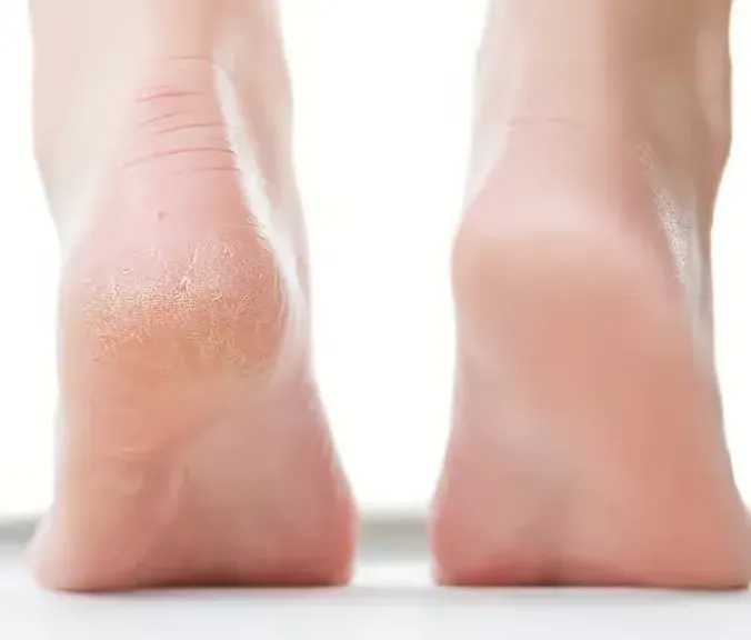 أفضل الوصفات لعلاج تشققات القدمين والحفاظ على نعومتها في فصل الشتاء