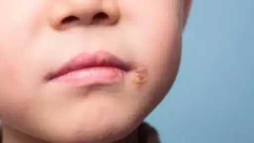 دليل المرأة لحماية أطفالها من قروح البرد.. الأسباب، الأعراض والعلاج دليل المرأة لحماية أطفالها من قروح البرد.. الأسباب، الأعراض والعلاج