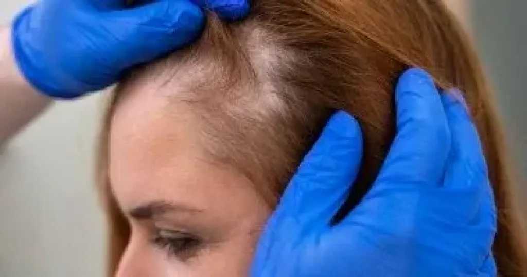 خمس وصفات طبيعية لاستعادة نمو الشعر الخفيف.. حلول عملية لـ”البيبي هير”