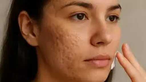 حيل منزلية للتخلص من حفر حب الشباب وتحسين مظهر البشرة