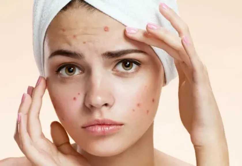 حلول طبيعية فعّالة للتخلص من حب الشباب والحفاظ على جمال بشرتك