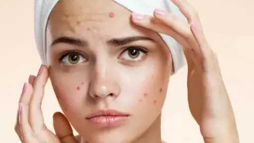 حلول طبيعية فعّالة للتخلص من حب الشباب والحفاظ على جمال بشرتك