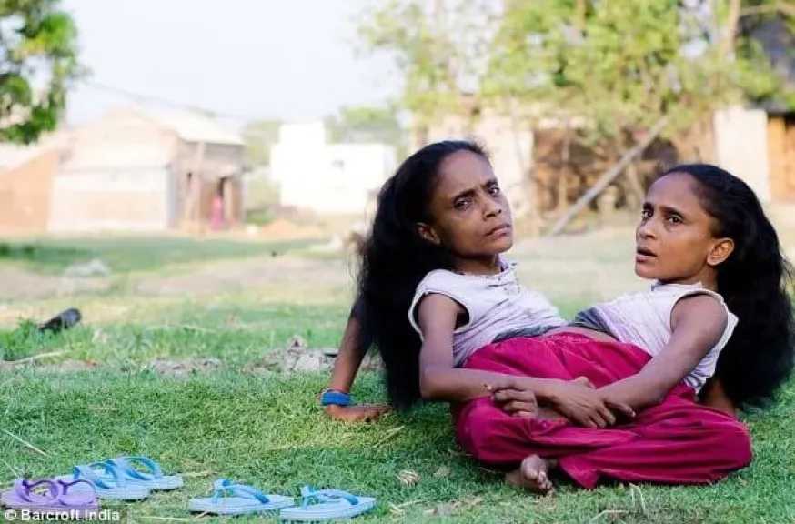 اليوم العالمي للتوائم الملتصقة.. قصص ملهمة للأمل والتحدي