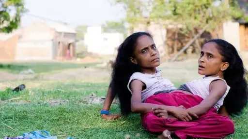 اليوم العالمي للتوائم الملتصقة.. قصص ملهمة للأمل والتحدي