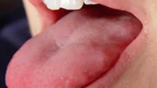 7  أسباب وراء عض اللسان أثناء النوم وكيفية تجنبها