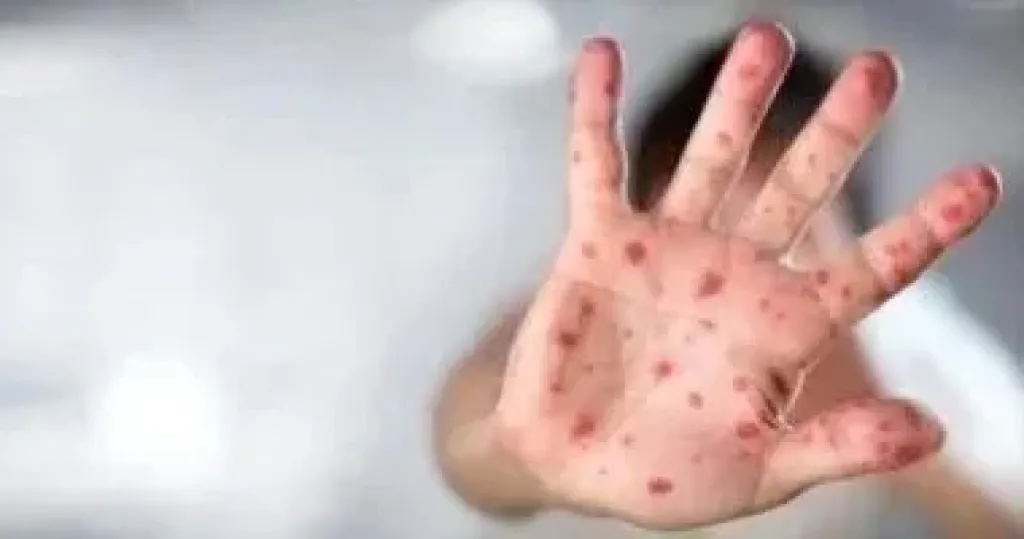 فيروس جدري القرود