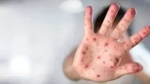 اكتشاف متحور جديد لفيروس جدري القرود في إنجلترا يثير اهتمام العلماء اكتشاف متحور جديد لفيروس جدري القرود في إنجلترا يثير اهتمام العلماء