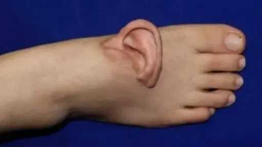 زراعة أذن في القدم... رحلة طبية مذهلة لإعادة الأمل بعد حادث مروع زراعة أذن في القدم... رحلة طبية مذهلة لإعادة الأمل بعد حادث مروع