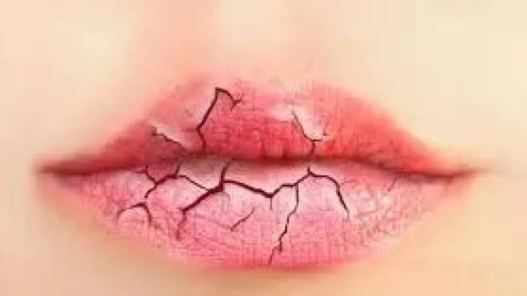 تشقق الشفاه