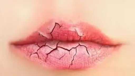كيف تحمي شفتيك من التشقق في فصل الشتاء؟ أسباب وعلاجات فعّالة كيف تحمي شفتيك من التشقق في فصل الشتاء؟ أسباب وعلاجات فعّالة