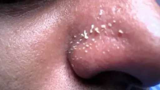 الرؤوس البيضاء.. الأسباب وطرق الوقاية والعلاج للحصول على بشرة نقية الرؤوس البيضاء.. الأسباب وطرق الوقاية والعلاج للحصول على بشرة نقية