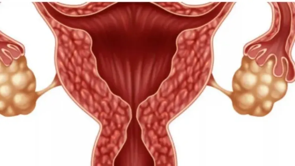 تكيس المبايض