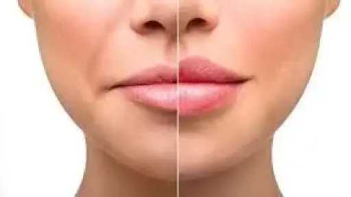 5 وصفات منزلية فعالة لعلاج تشقق الشفاه خلال الشتاء