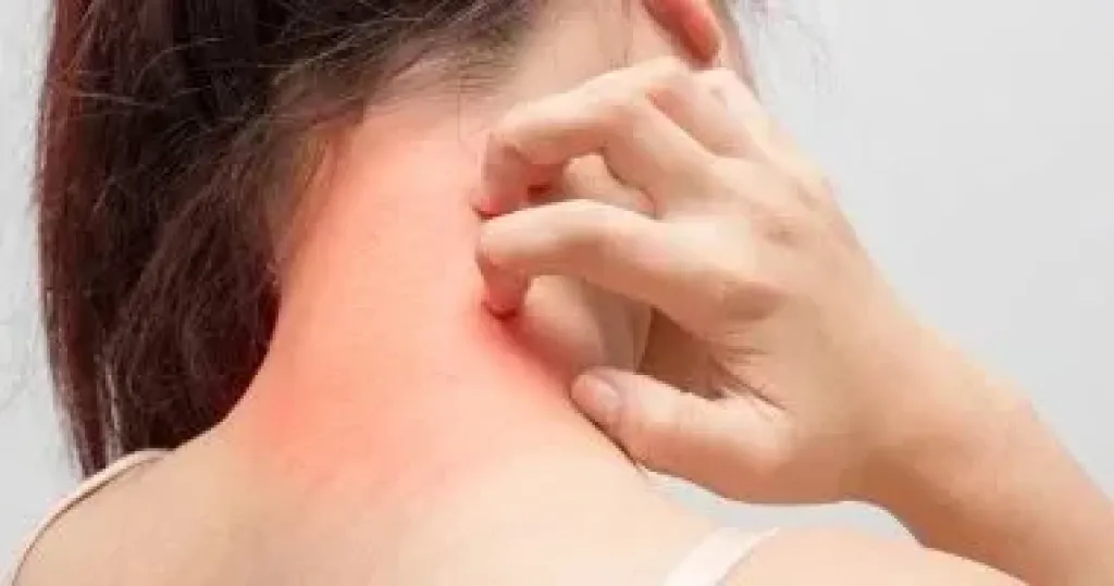 مرضى الصدفية