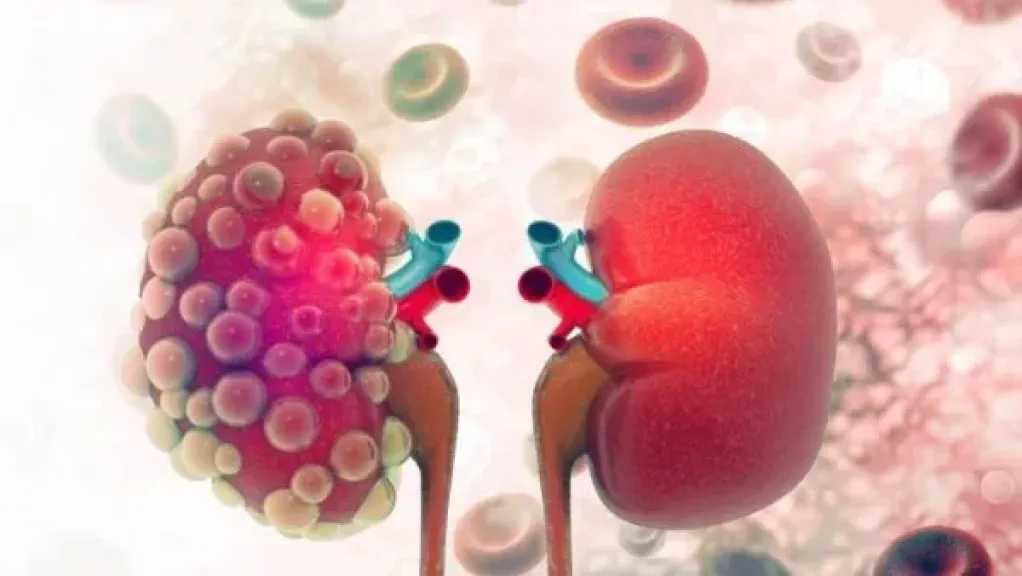 الكشف المبكر سر الوقاية.. تعرف على أعراض سرطان الكلى وكيفية التصرّف