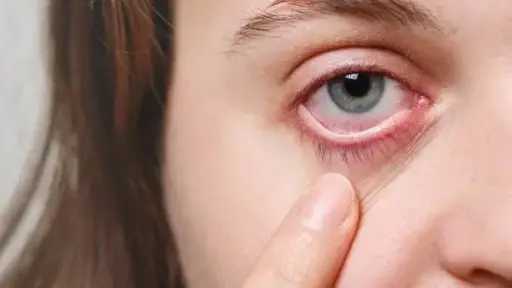 حلول فعّالة لعلاج جفاف العين في المنزل دون أدوية