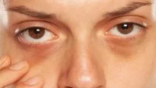 الهالات السوداء.. هل هي علامة على الإرهاق فقط أم مؤشر لمشكلة صحية خطيرة؟