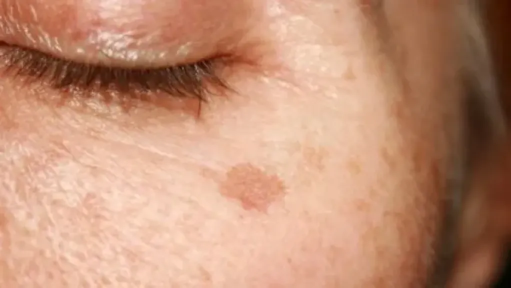 بقع التقدم في العمر